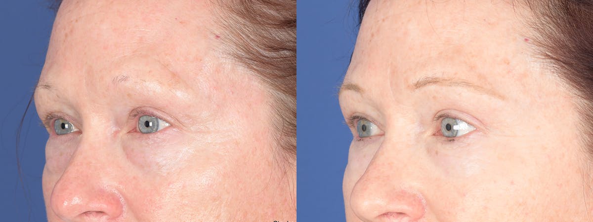 Blepharoplasty Before & After Gallery - Patient 193488 - Image 3