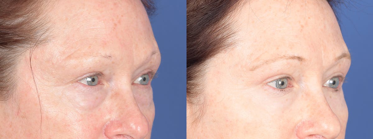 Blepharoplasty Before & After Gallery - Patient 193488 - Image 4