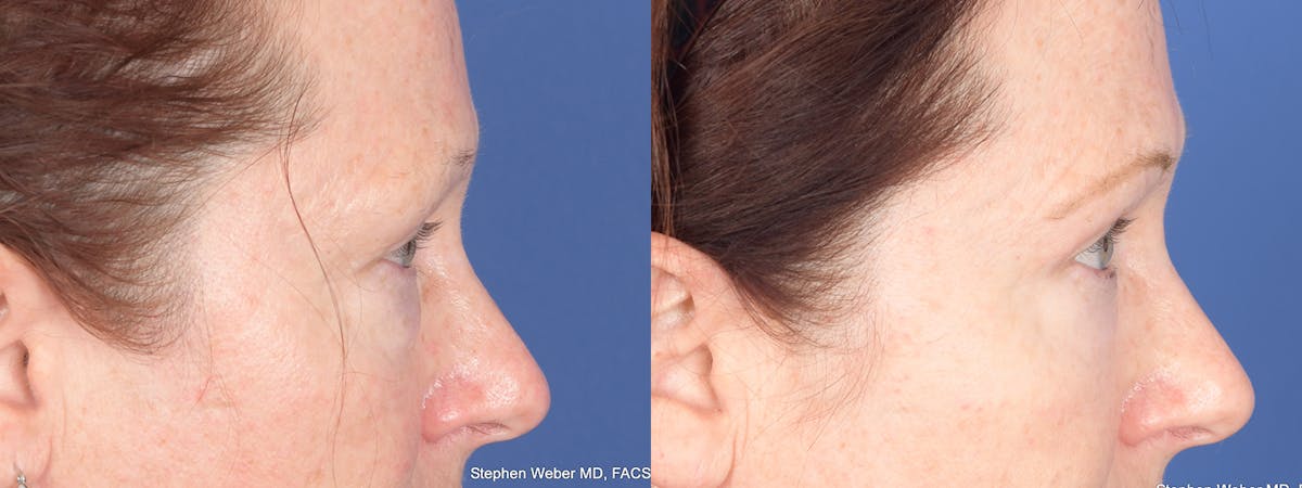 Blepharoplasty Before & After Gallery - Patient 193488 - Image 5
