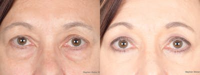 Blepharoplasty Before & After Gallery - Patient 176750 - Image 1
