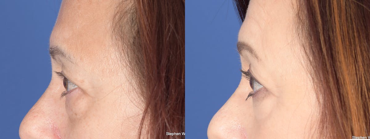 Blepharoplasty Before & After Gallery - Patient 176750 - Image 2