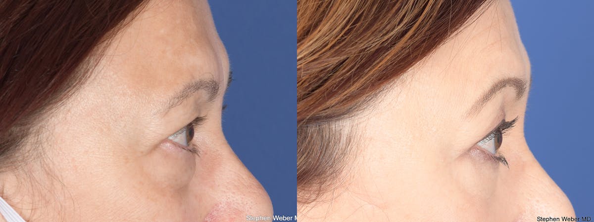 Blepharoplasty Before & After Gallery - Patient 176750 - Image 3