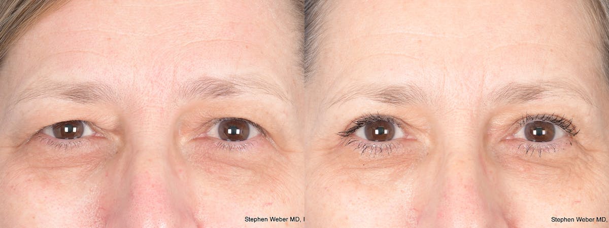 Blepharoplasty Before & After Gallery - Patient 373111 - Image 1