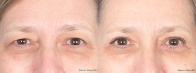 Blepharoplasty Before & After Gallery - Patient 373111 - Image 1