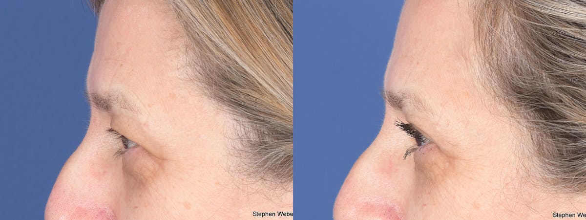 Blepharoplasty Before & After Gallery - Patient 373111 - Image 2