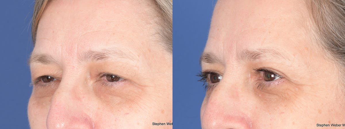 Blepharoplasty Before & After Gallery - Patient 373111 - Image 3