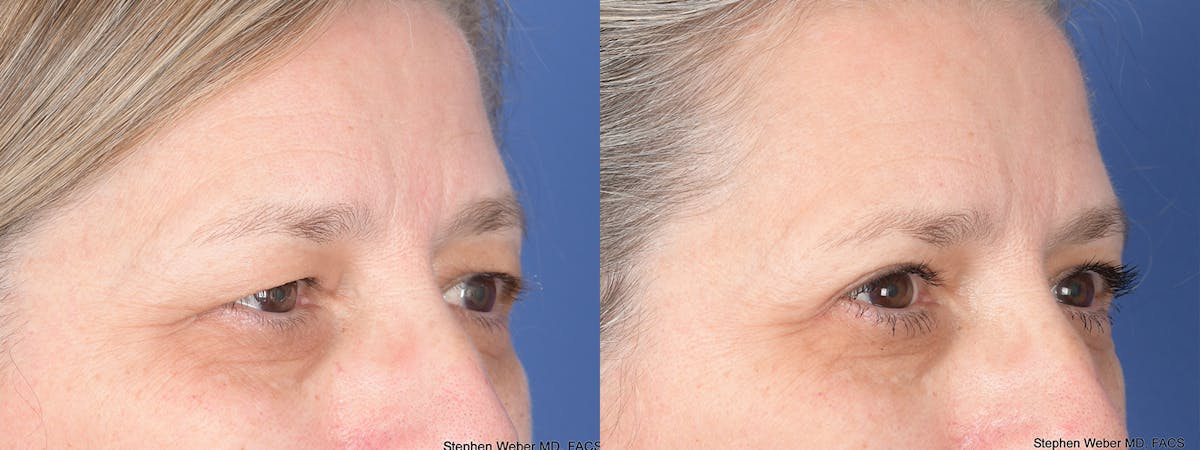 Blepharoplasty Before & After Gallery - Patient 373111 - Image 4