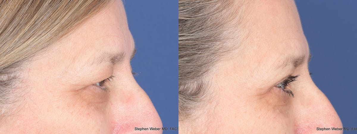 Blepharoplasty Before & After Gallery - Patient 373111 - Image 5