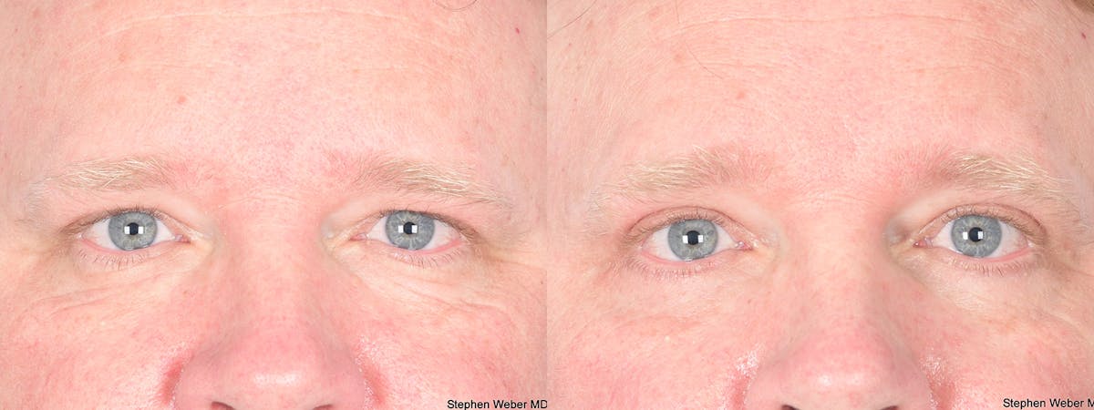 Blepharoplasty Before & After Gallery - Patient 368566 - Image 1