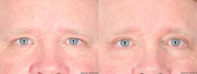 Blepharoplasty Before & After Gallery - Patient 368566 - Image 1