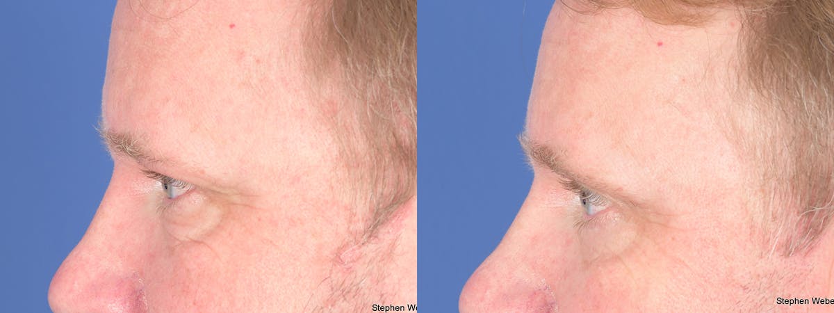 Blepharoplasty Before & After Gallery - Patient 368566 - Image 2