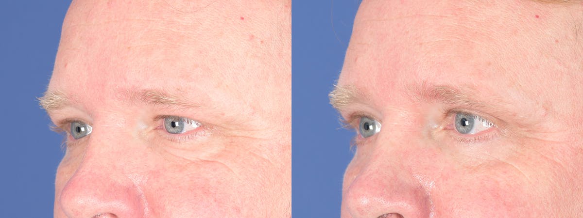 Blepharoplasty Before & After Gallery - Patient 368566 - Image 3