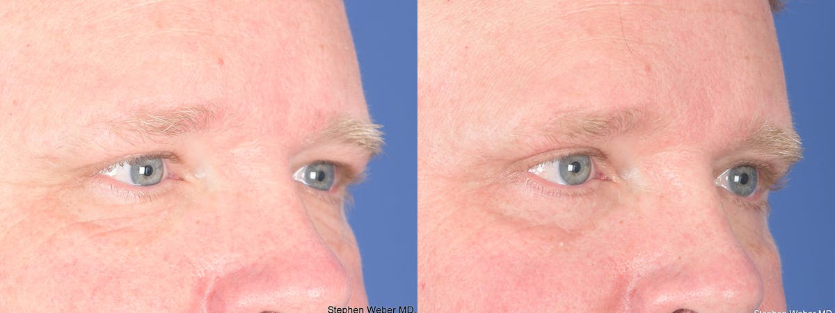 Blepharoplasty Before & After Gallery - Patient 368566 - Image 4