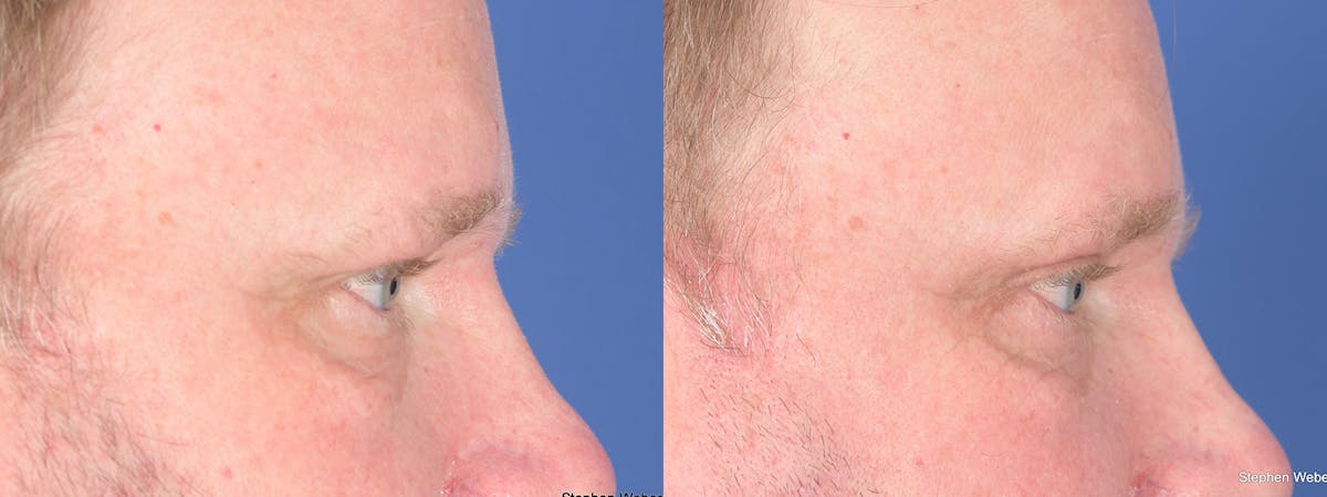 Blepharoplasty Before & After Gallery - Patient 368566 - Image 5