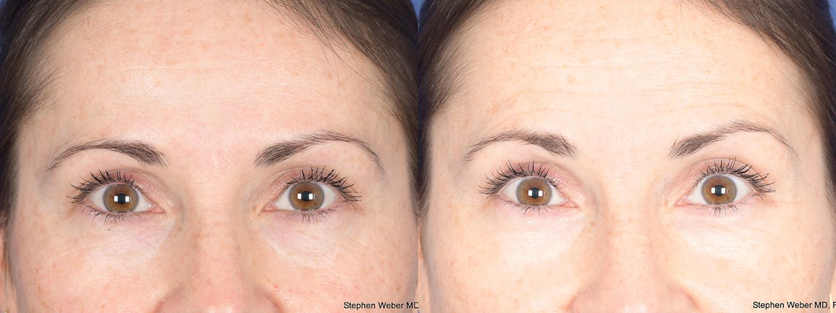 Blepharoplasty Before & After Gallery - Patient 192292 - Image 1