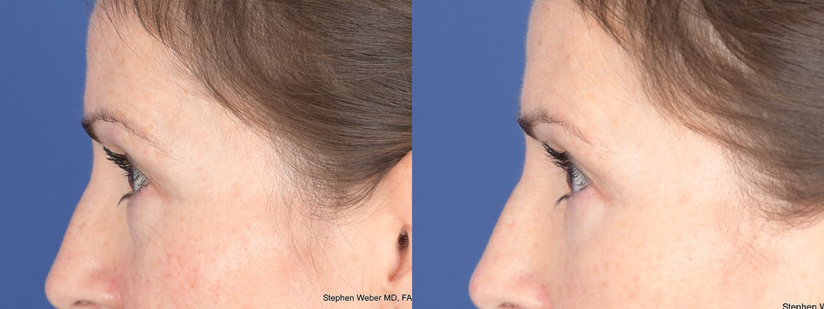 Blepharoplasty Before & After Gallery - Patient 192292 - Image 2