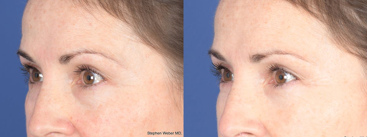 Blepharoplasty Before & After Gallery - Patient 192292 - Image 3