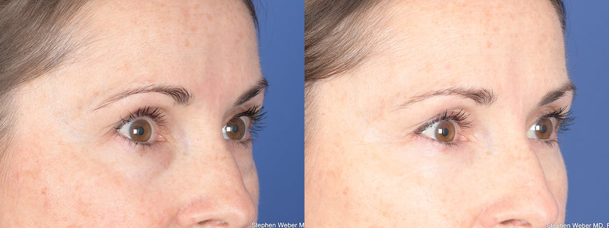 Blepharoplasty Before & After Gallery - Patient 192292 - Image 4