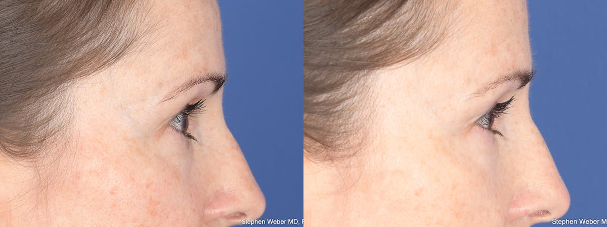 Blepharoplasty Before & After Gallery - Patient 192292 - Image 5