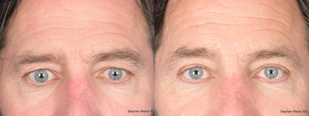 Blepharoplasty Before & After Gallery - Patient 960283 - Image 1
