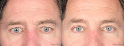 Blepharoplasty Before & After Gallery - Patient 960283 - Image 1