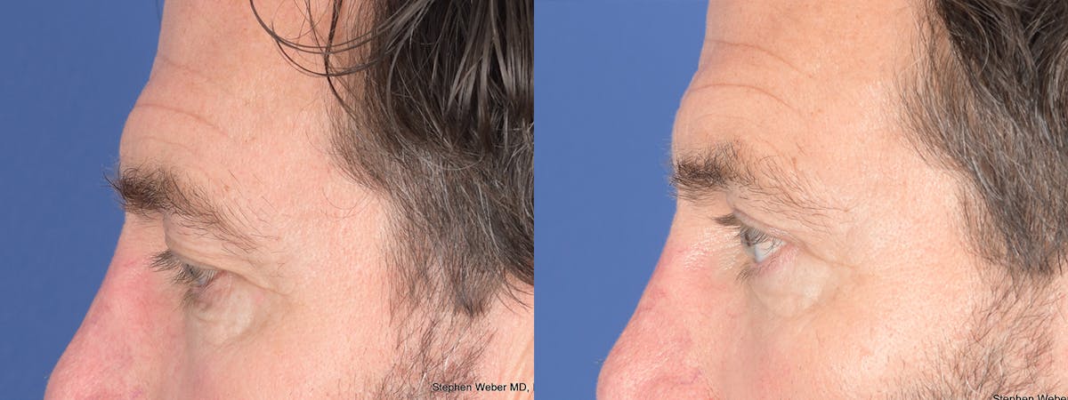Blepharoplasty Before & After Gallery - Patient 960283 - Image 2