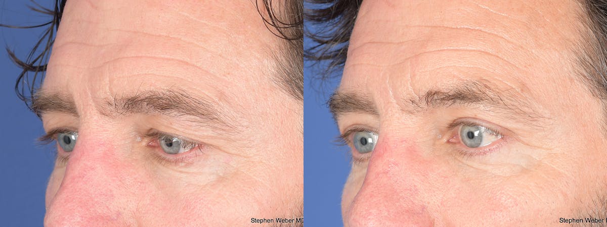 Blepharoplasty Before & After Gallery - Patient 960283 - Image 3