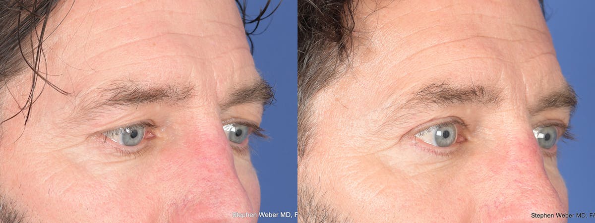 Blepharoplasty Before & After Gallery - Patient 960283 - Image 4