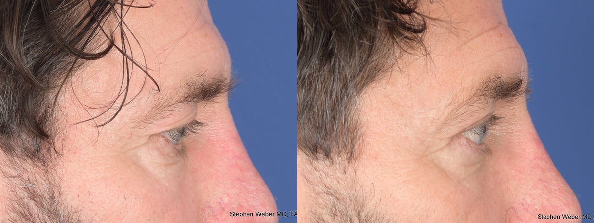 Blepharoplasty Before & After Gallery - Patient 960283 - Image 5