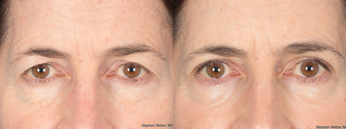 Blepharoplasty Before & After Gallery - Patient 117581 - Image 1