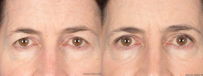 Blepharoplasty Before & After Gallery - Patient 117581 - Image 1