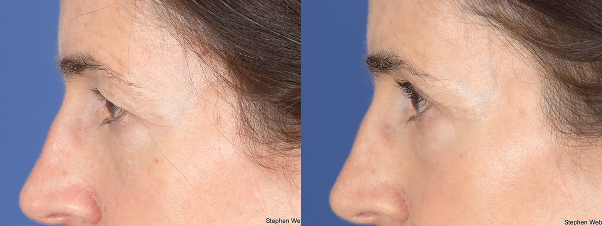 Blepharoplasty Before & After Gallery - Patient 117581 - Image 2