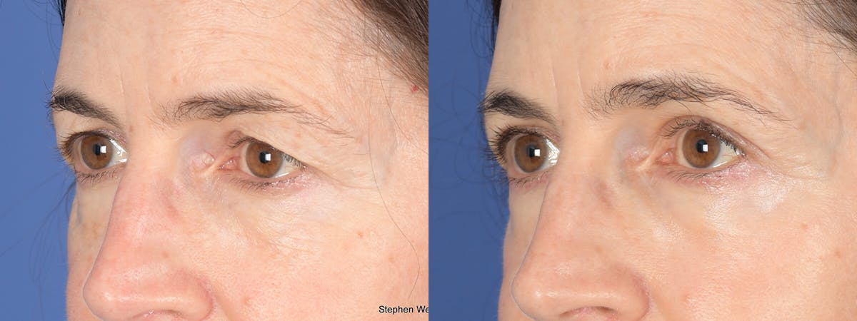 Blepharoplasty Before & After Gallery - Patient 117581 - Image 3