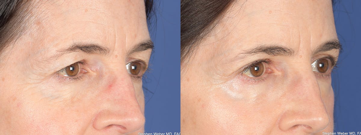 Blepharoplasty Before & After Gallery - Patient 117581 - Image 4