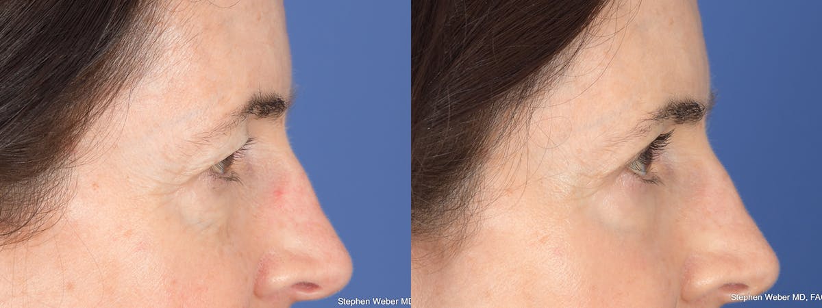 Blepharoplasty Before & After Gallery - Patient 117581 - Image 5