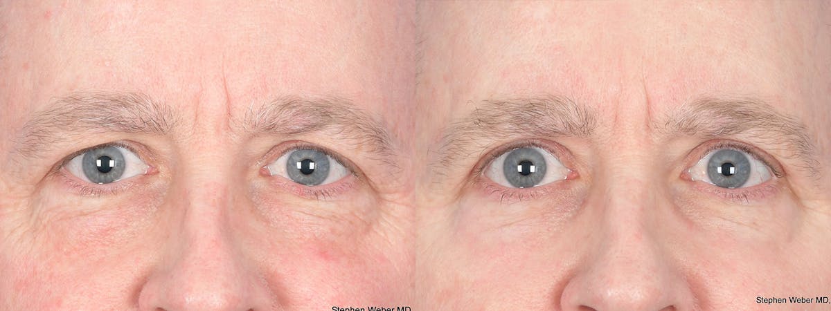 Blepharoplasty Before & After Gallery - Patient 255108 - Image 1