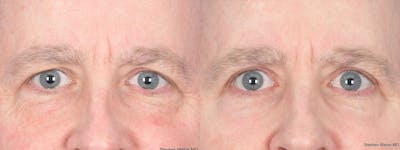 Blepharoplasty Before & After Gallery - Patient 255108 - Image 1