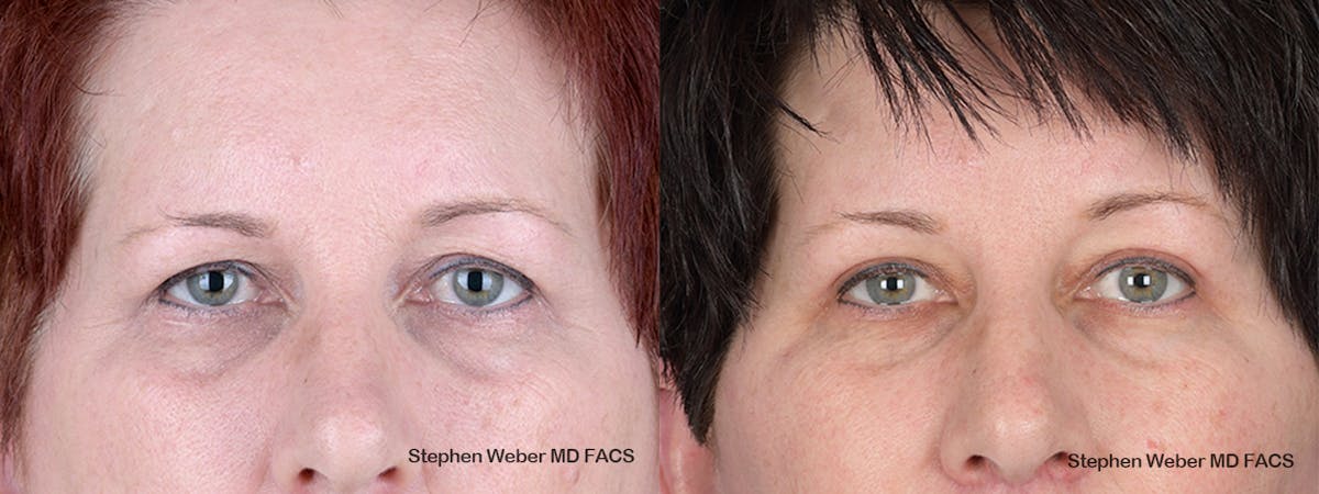 Blepharoplasty Before & After Gallery - Patient 737117 - Image 1