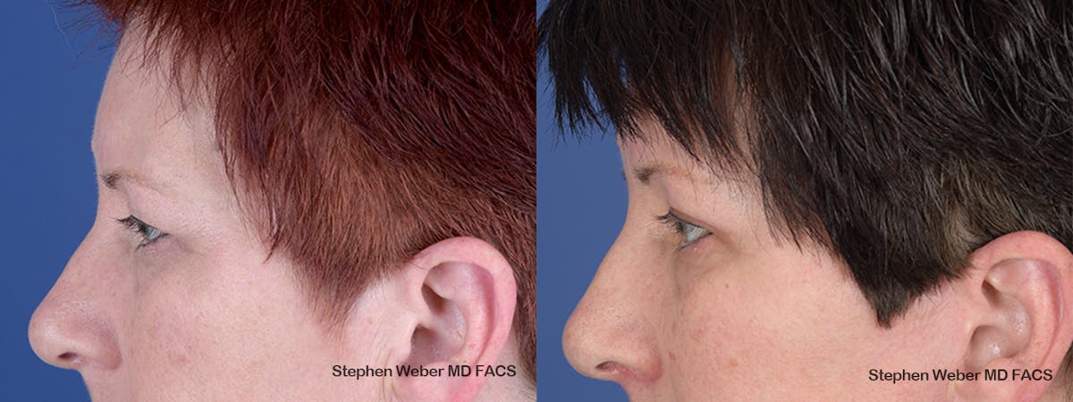 Blepharoplasty Before & After Gallery - Patient 737117 - Image 2