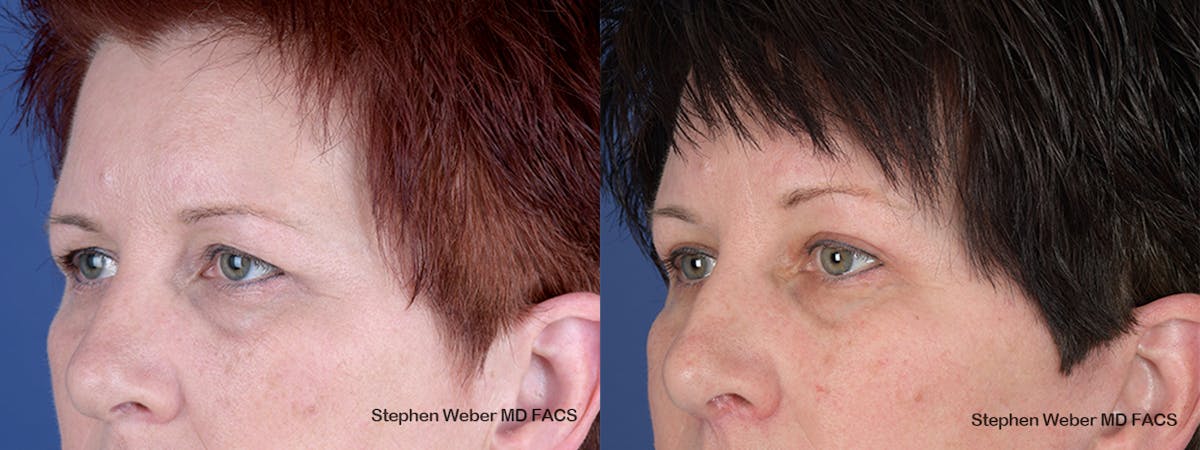 Blepharoplasty Before & After Gallery - Patient 737117 - Image 3