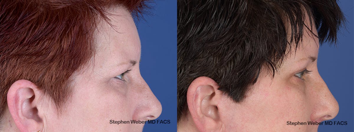 Blepharoplasty Before & After Gallery - Patient 737117 - Image 4