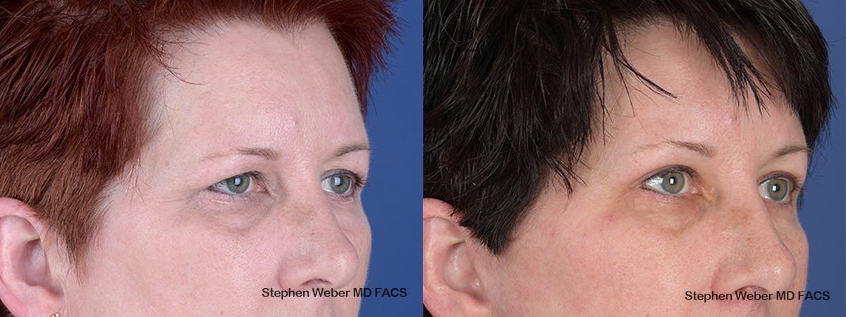 Blepharoplasty Before & After Gallery - Patient 737117 - Image 5