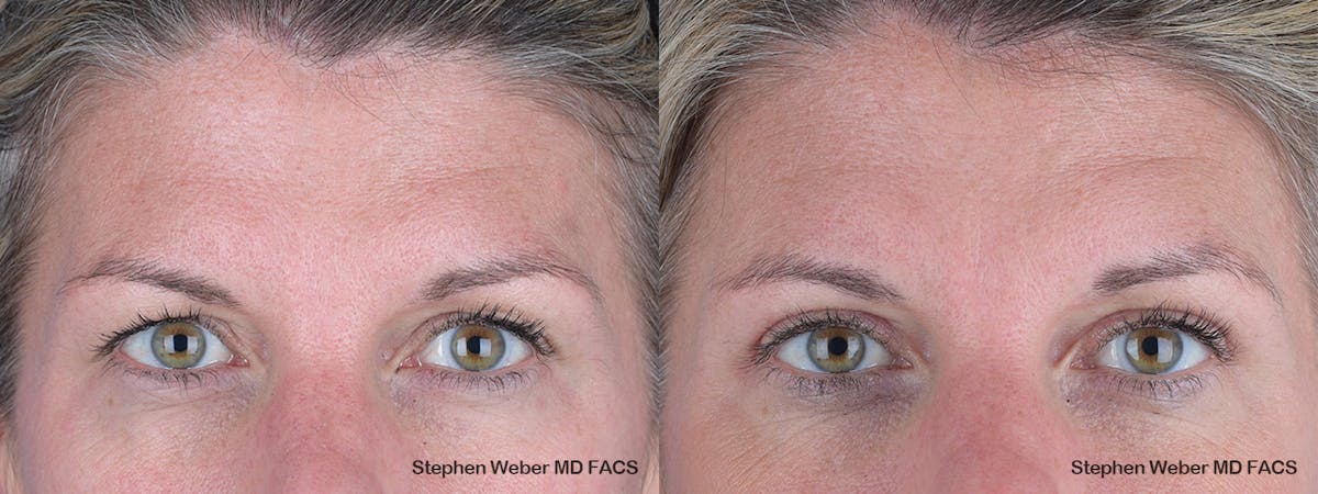 Blepharoplasty Before & After Gallery - Patient 243724 - Image 1