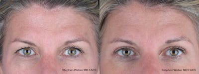 Blepharoplasty Before & After Gallery - Patient 243724 - Image 1