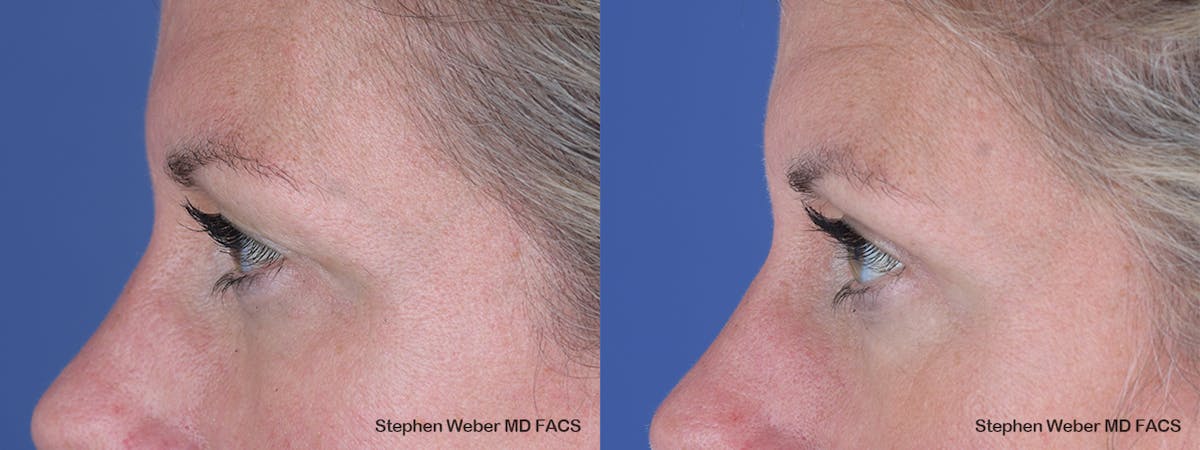 Blepharoplasty Before & After Gallery - Patient 243724 - Image 2