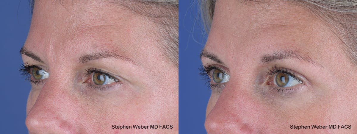 Blepharoplasty Before & After Gallery - Patient 243724 - Image 3