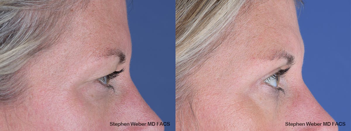 Blepharoplasty Before & After Gallery - Patient 243724 - Image 4
