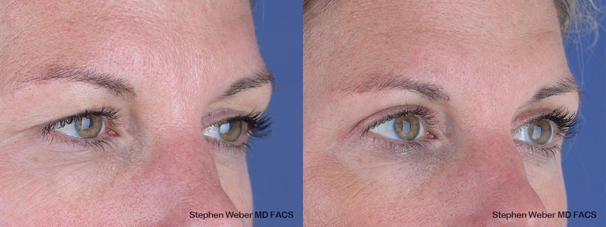 Blepharoplasty Before & After Gallery - Patient 243724 - Image 5