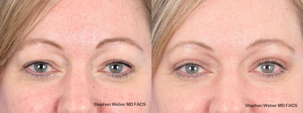 Blepharoplasty Before & After Gallery - Patient 313903 - Image 1