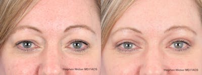 Blepharoplasty Before & After Gallery - Patient 313903 - Image 1